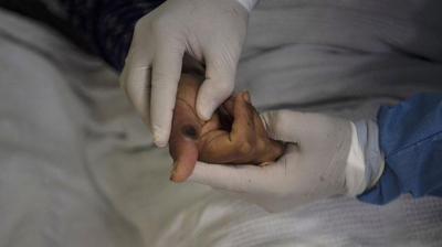 الكونغو: 1000 إصابة جديدة بجدري القرود خلال أسبوع